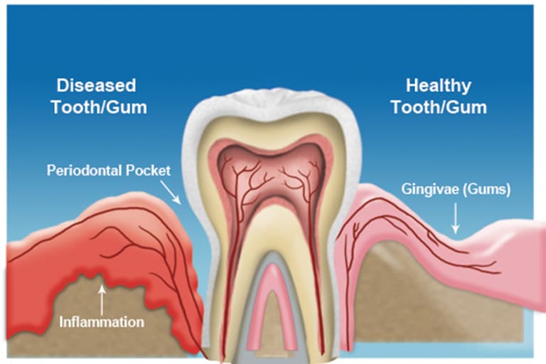 diseased tooth