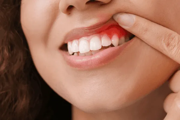 Woman reveals redness of gums by pushing back her lip.