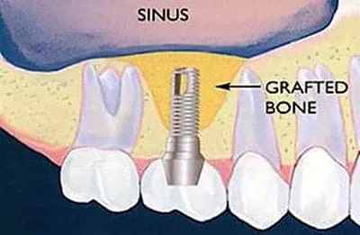 Illustration of the sinus with an implant and bone grafting.