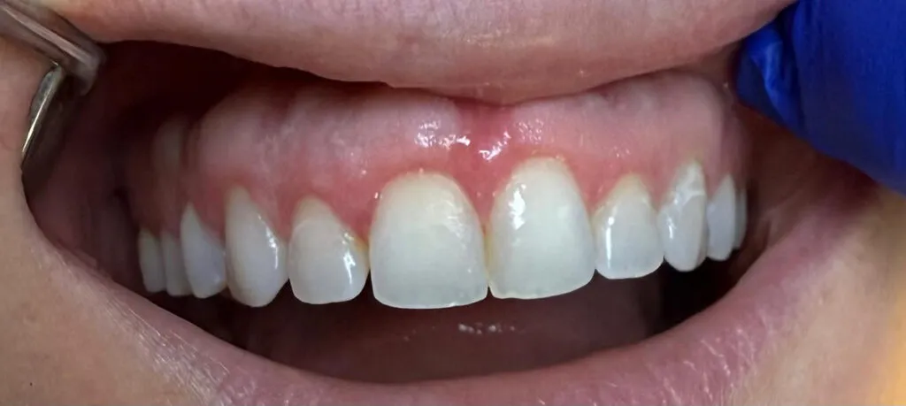 Gummy smile treatment after