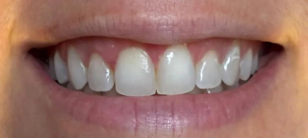 Gummy smile treatment after