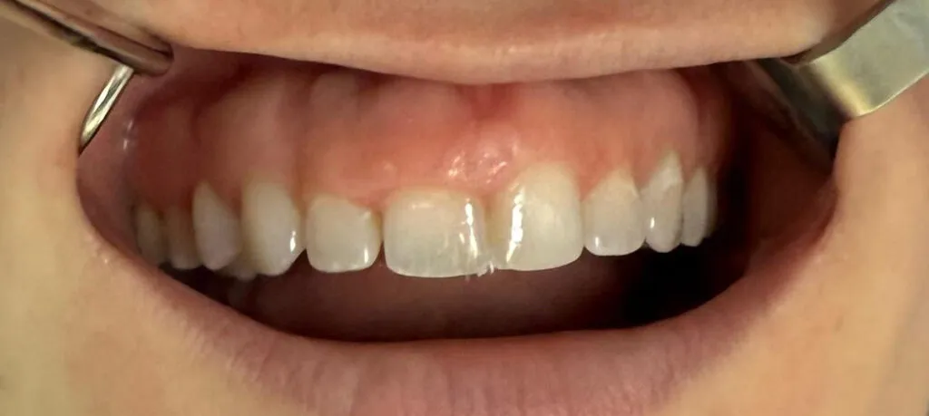 Gummy smile treatment before