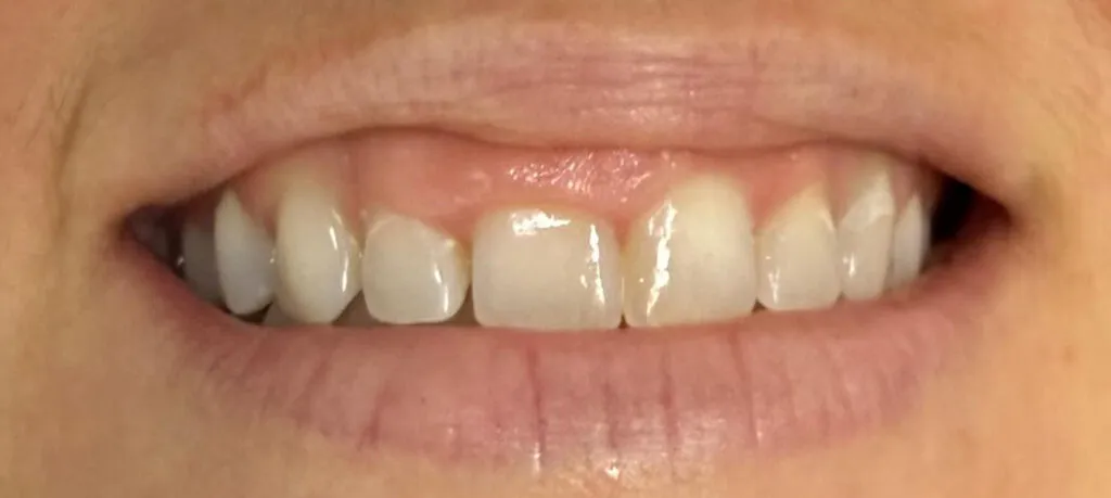 Gummy smile treatment before