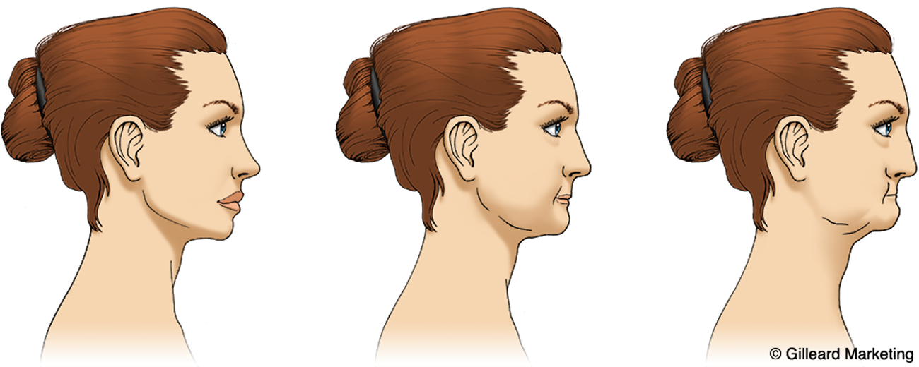 Illustration showing how the lower face and jawline change as jawbone shrinks after tooth loss