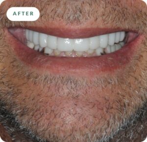 After New Teeth in One Day: full smile with a fixed implant bridge