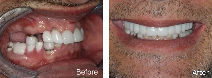 Before and after fixed implant bridge: missing and failing teeth before, full restored smile after