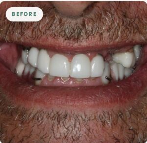Patient smile before fixed bridge treatment at Dallas Periodontal Associates