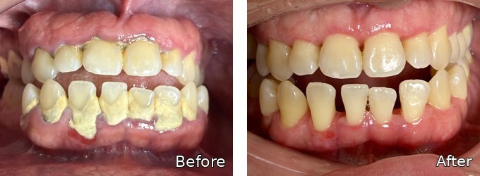 Before and after gum disease treatment at Dallas Periodontal Associates, case 4