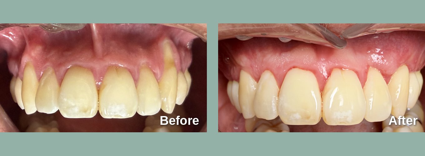 Before and after gum recession treatment, upper front teeth