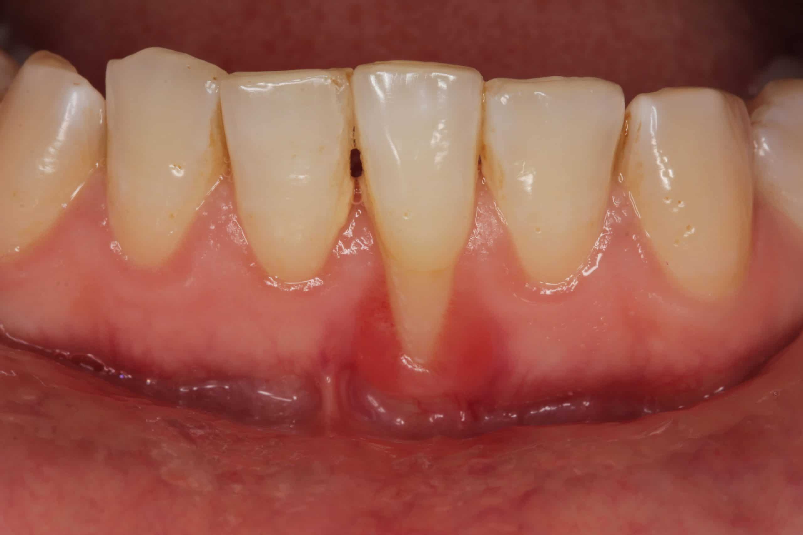 Gum Disease Treatment & | Dallas