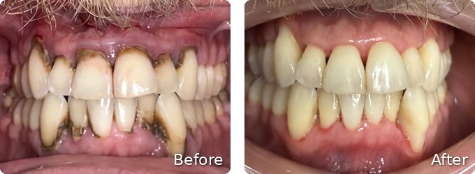 Before and after gum disease treatment at Dallas Periodontal Associates, case 5